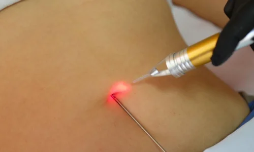 تجربتي مع شفط الدهون بالفيزر في تركيا