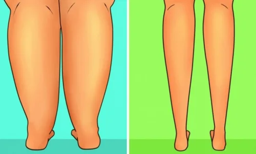 تجربتي مع شفط دهون الساق