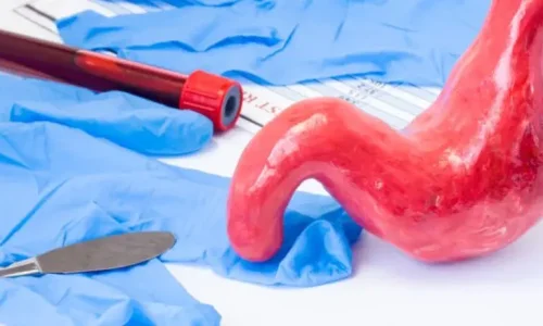 متى تلتئم المعده بعد التكميم؟