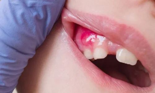 تعرف على علاج الخراج الاسنان بالمره