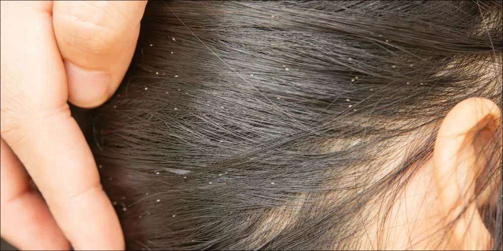 أهم 20 تفسير لحلم القملة لابن سيرين