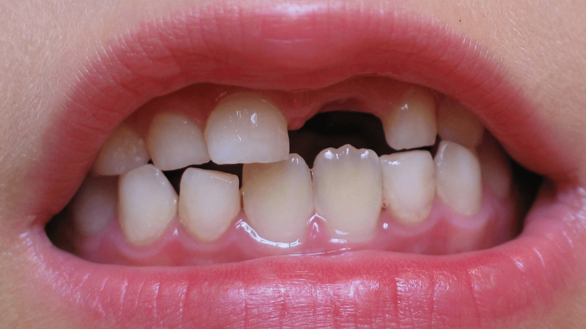 تفسير رؤية سقوط الأسنان بدون دم لابن سيرين